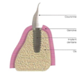 implant